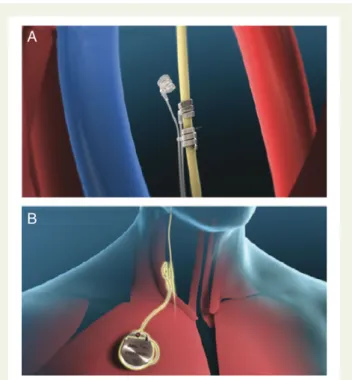Figure 2 (A) Investigational bipolar helical vagal cuff. (B) Precision (TM) Pulse Generator and implanted lead.