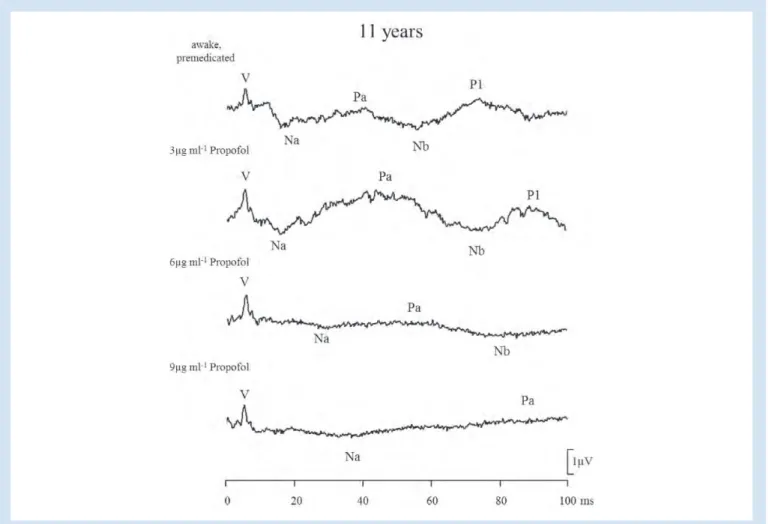 Fig 2 Original MLAEP curves of an 11-yr-old boy. 5 ## †††§§§ *** *** **432 1 0 0 3 6