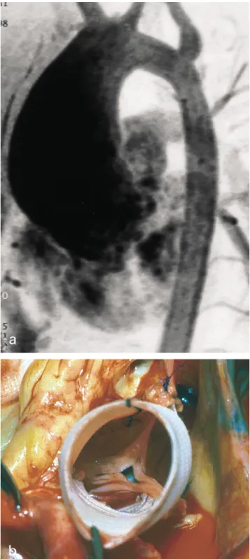 Fig. 2. (a) Severe supracoronary dilatation of the ascending aorta (7 cm) in a 12-year-old patient without aortic valve dysfunction
