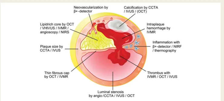 Figure 1 Conceptual graphics illustrating how invasive and non-invasive imaging modalities could combine to provide an integrated assess- assess-ment of microanatomical and biological features of an unstable coronary plaque