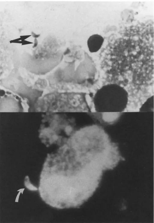 Figure 1. Tachyzoites of Toxoplasma gondii (arrows) in bronchial lavage fluid from an HlY-infected patient with  pneu-monia and respiratory distress syndrome 