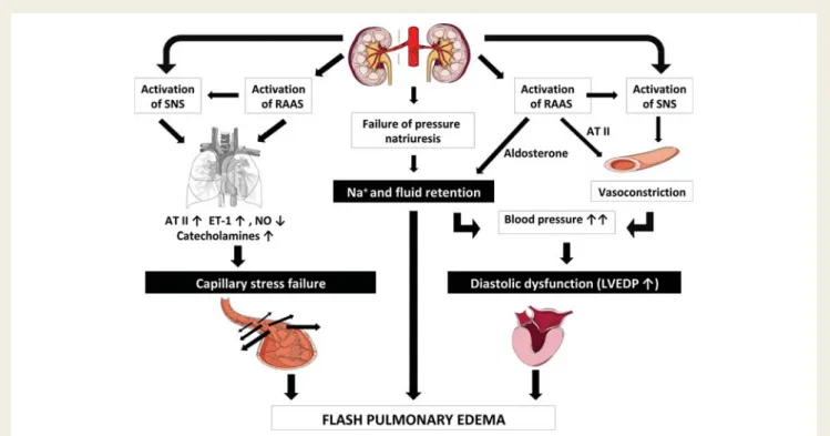Figure 1 The Pickering Syndrome. Three main pathophysiological mechanisms contribute to the development of flash pulmonary oedema: