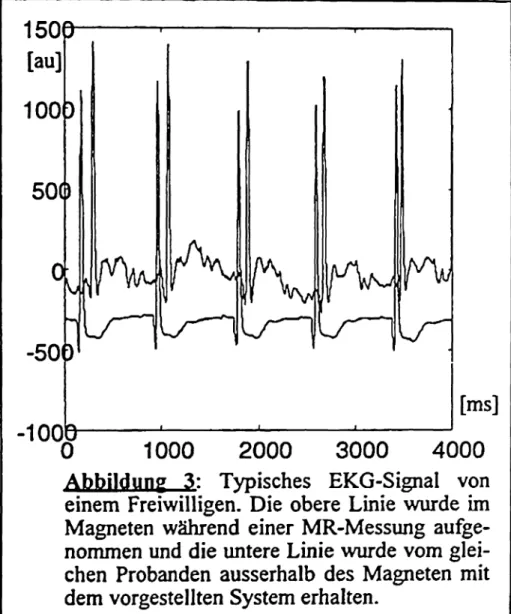 Abbildung 3: Typisches EKG-Signal von einem Freiwilligen. Die obere Linie wurde im Magneten während einer MR-Messung  aufge-nommen und die untere Linie wurde vom  glei-chen Probanden ausserhalb des Magneten mit dem vorgestellten System erhalten.