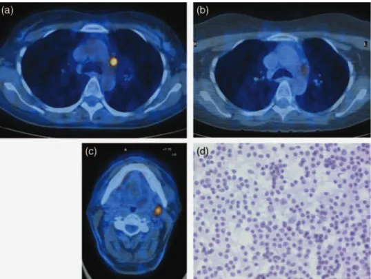 Figure 2: A 61-year-old man with a large-cell carcinoma of the left upper lobe and ipsilateral mediastinal lymph node invasion