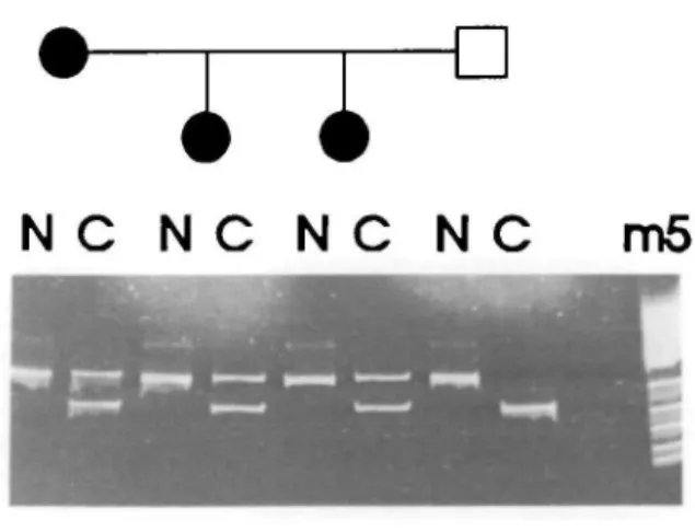 Figure 1 shows the TaqI digestion of the PCR products from the reported family. Affected individuals reveal 2 bands while only one is present in the unaffected father