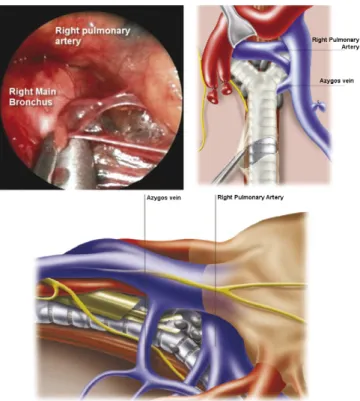 Fig. 2. Cervical videomediastinoscopy.