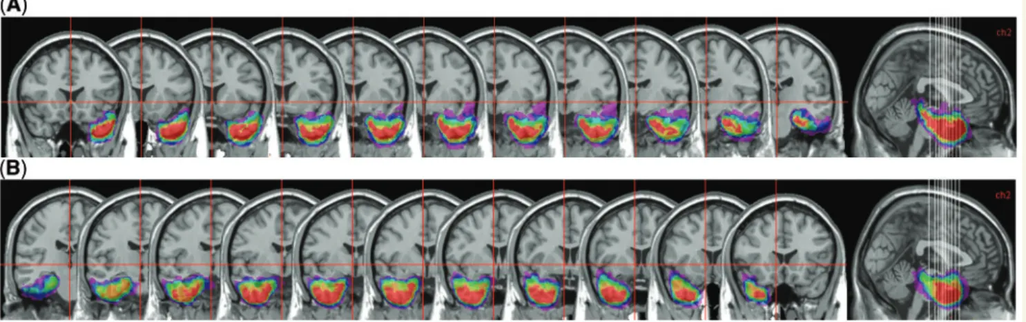 Figure 1 Anatomical reconstruction of the patients’ brain lesions. (A) Areas of overlap across patients with right lobectomy and (B) left lobectomy