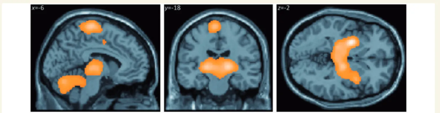 Figure 1 SPM(t) map of regional cerebral blood flow differences for the contrast of move versus rest (P 5 0.05, corrected) averaged across all three groups
