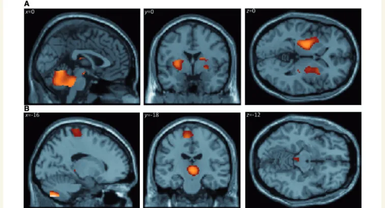 Table 4 Cluster peaks of increased normalized regional cerebral blood flow for the contrast psychogenic dystonia versus control subjects averaged across all tasks, within a core motor network, thresholded P 5 0.05, family-wise error corrected for multiple 