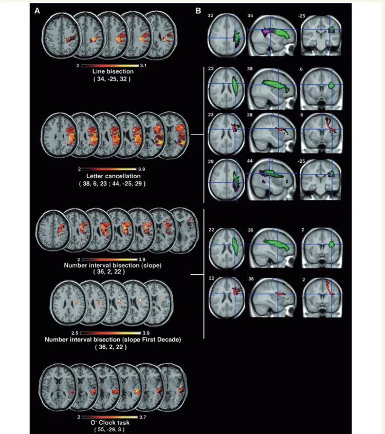 Figure 3 Study 2. (A) Representative slices from maps showing the anatomical correlates of the rightward attentional bias in the line bisection, letter cancellation, number interval bisection and O’Clock tasks in the entire sample of patients with right br