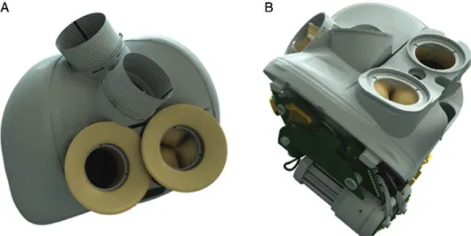 Figure 1: CARMAT TAH. (A) Compliance bag surrounding the prosthesis; atrial suture ﬂ anges and ejection conduits