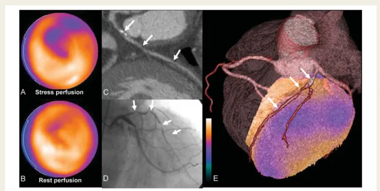 Figure 3 shows the study population subcategorized according to the presence or absence of flow-limiting stenoses on CTA/MPI or QCA/MPI and the treatment strategy (revascularization vs