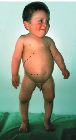 Fig. 1. The patient at the age of 3.5 years. Note the small stature (height: 74 cm), the moonlike face, the grossly enlarged liver and the genua vara due to severe rickets.