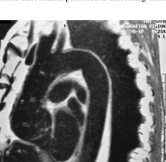 Fig. 1. A MR image obtained in a 62-year-old man 4 years after surgical repair of a type A aortic dissection using GRF-glue