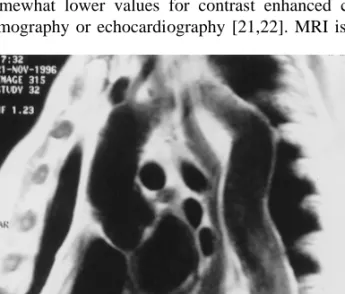Fig. 4. The axial MR image demonstrates the dissection in the enlarged aortic arch with patent true and false lumen.