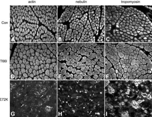 Figure 2. Nebulin immunostaining may be abnormal in NM patients with a primary actin mutation