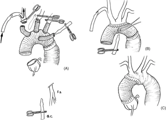 Fig. 1. Technique with single axillary artery cannulation, for total aortic arch replacement (A and B) and hemi-arch replacement (C) with a median sternotomy