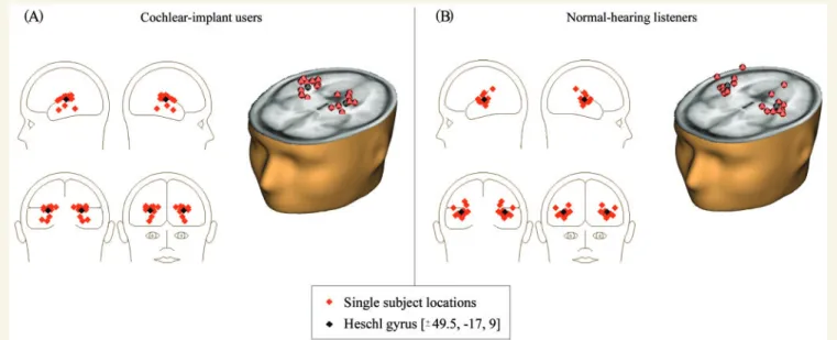 Figure 4 Single subject source localization of N1-auditory evoked potentials for cochlear implant users (A) and normal hearing listeners (B)