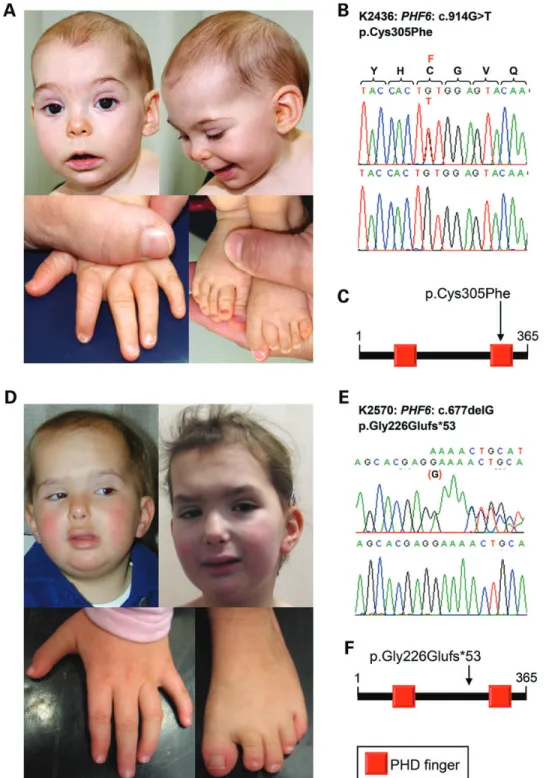 Figure 1. Phenotype of females with PHF6 mutation. (A)Individual K2436 at the age of 12 months with sparse hair, pointed eyebrows with synophrys, long philtrum, thin upper and thick lower vermillion border