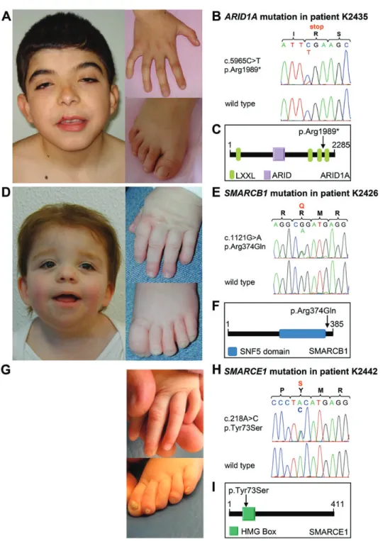 Figure 2. Clinical findings of CSS individuals with ARID1A, SMARCB1 and SMARCE1 mutations