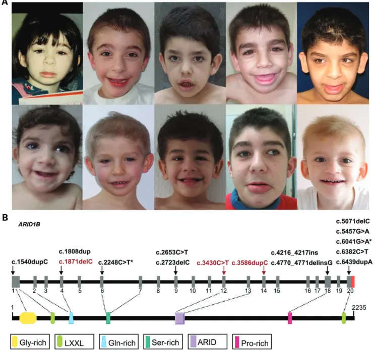 Figure 3. Craniofacial phenotype of individuals with ARID1B mutation. (A) Upper row from left to right: Individuals K2574, K2434, K2441, K2474 and K2471.