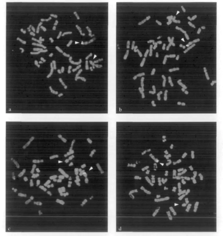 Figure 2. FISH studies in four patients with  3 p - syndrome. In each case there is a hybridization signal from the normal chromosome 3pter but not from the deleted homologue