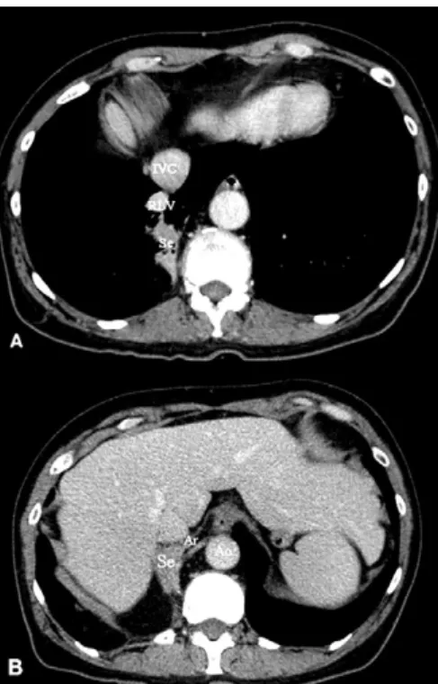 Fig. 2. (A) Three dimensional reconstructed computed tomography image showing the venous drainage of the right lower lobe directly in the inferior vena cava (white arrow)