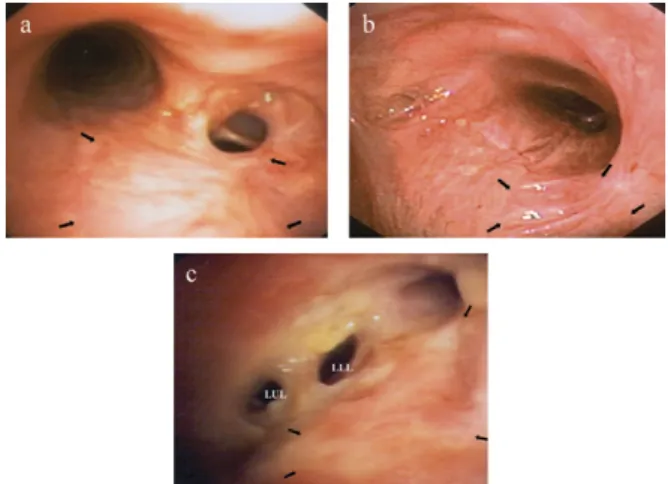 Fig. 6 shows the outcome of six patients undergoing closure of airway defects by muscle flaps in the presence of complex airway reconstructions such as reinforcement of the muscle flap with embedded rib segment or integration of the flap in carinal anastom