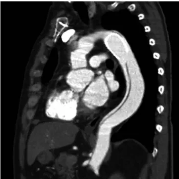 Figure 5: Membrane rupture at the distal end of the stent-sagittal view.