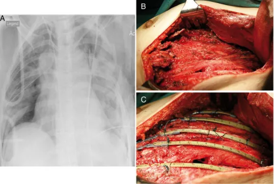 Figure 2: (A) Chest X-ray after a severe blunt chest trauma showing bilateral dislocated rib fractures and a left haemothorax