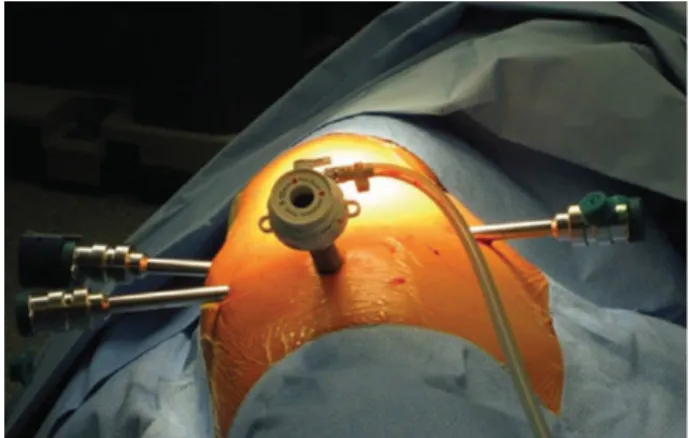 Figure 1: Port mapping for lobectomy on the right. The camera port is placed in the seventh to eighth intercostal space on the midaxillary line (12 mm, 30°