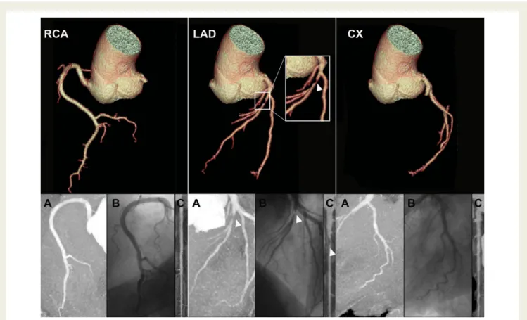 Figure 1 Low-dose CT and invasive coronary angiography in a 42-year-old male patient with atypical chest pain