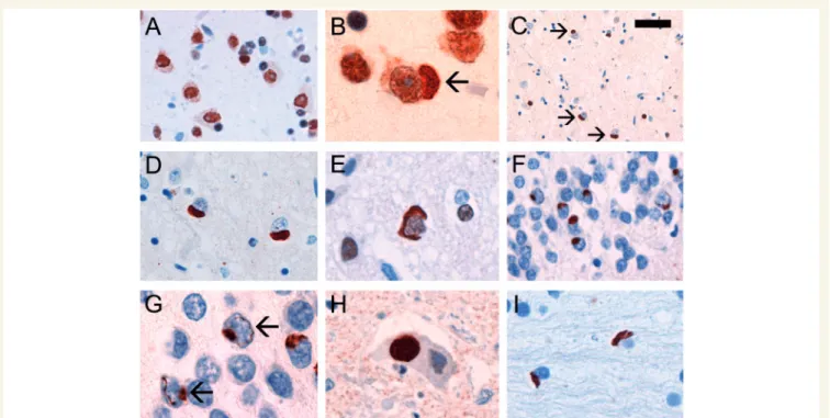Figure 1 FUS IHC performed on sections of post-mortem brain tissue from normal control (A) and aFTLD-U subjects (B–I)