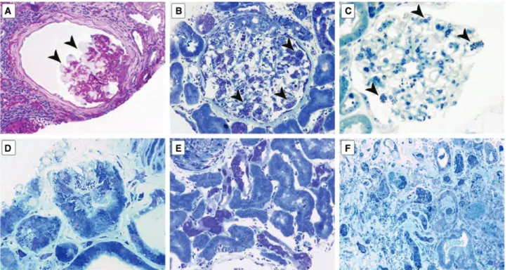 Fig. 2. Vacuolization and glycosphingolipid deposits in Fabry nephropathy. (A) The glomerulus shows vacuolization of podocytes (arrowheads), and mild corrugation of glomerular basement membranes, with periglomerular and interstitial fibrosis (periodic acid