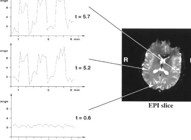 Figure 2. Representative intensity time courses and corresponding t-values of three different pixels within the functional image series induced by binaural, pulsed sine tone stimulation