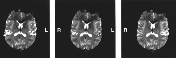 Figure 3. Example of cortical response upon binaural and monaural stimulation (volunteer no