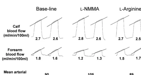 Fig. 1. Segments of simultaneous recordings of forearm and calf blood flow in a subject with thoracic sympathectomy obtained at base-line, and during