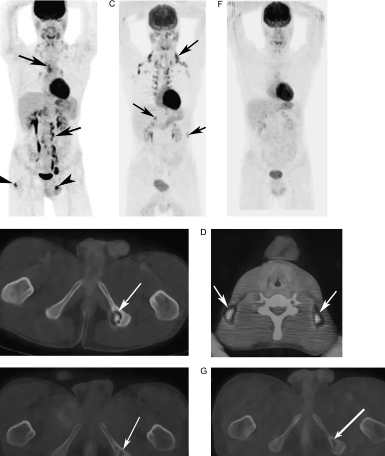 Figure 4. A 17-year-old patient with histologically proven Hodgkin’s disease (HD). Coronal maximum intensity projection (MIP) image (a) of the baseline positron emission tomography/computed tomography (PET/CT) before therapy showing supradiaphragmatic (upp