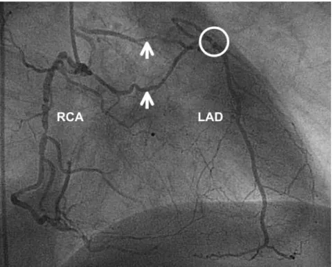 Figure 2 Coronary angiogram of a patient with contrast injection into the right coronary artery (RCA) and complete ﬁlling via collateral arteries (arrows) of the chronically occluded left anterior descending coronary artery (LAD)