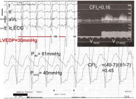 Figure 3 Simultaneous recordings in a patient with insufﬁcient collateral ﬂow of four ECG leads (surface leads and intracoronary, i.c., lead), LVEDP (scale 40 mmHg), phasic aortic pressure (P ao , scale 200 mmHg), phasic coronary occlusive pressure (P occl