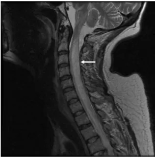 Figure 1. MRI of the patient’s cervical cord. The T2 sequence demonstrated severe cord swelling suggestive of cord infarction.