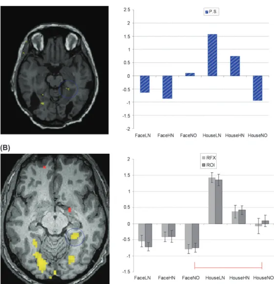 Figure 3. Activation of the right parahippocampal gyrus. (A) In P.S., the House [ Face contrast showed no significant activation at conventional threshold, although a small cluster was observed at P 5 0.10