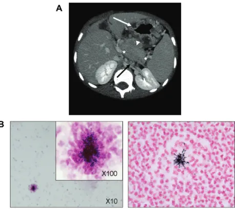 Figure 1. A, Radiologic signs of abdominal actinomycosis on a computed tomographic (CT) scan (patient 6)
