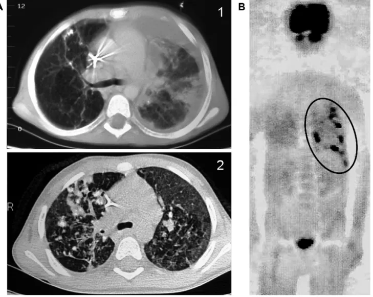 Figure 2. Radiologic signs of pulmonary actinomycosis (patient 10). A, High-resolution computed tomographic (CT) scan showing (1) focal consolidation, mediastinal and hilar lymph node enlargement, pleural effusion, and granulomatous lesions with partial ca
