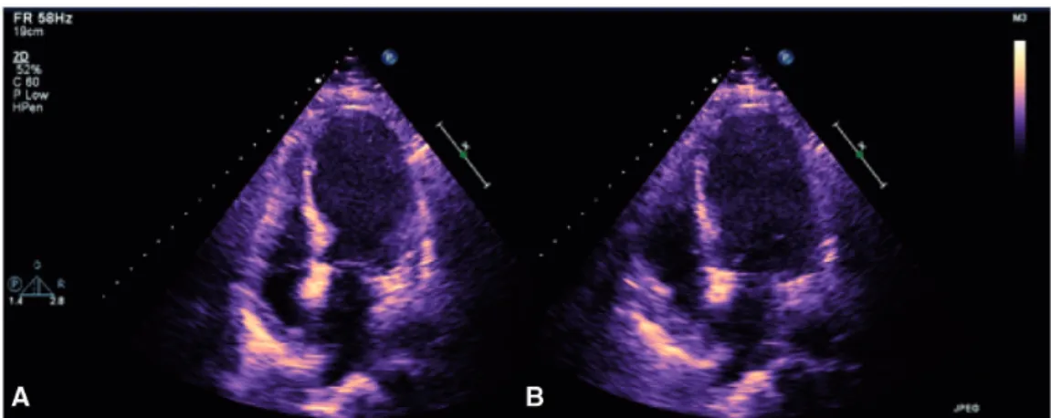 Figure 1. Echocardiography reveals left ventricular ejection fraction of 35% with apical ballooning pattern (A in systole and B in diastole).