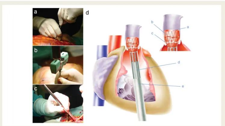 Figure 3 Minimally invasive tissue engineered heart valves implantation. After sternal bone marrow puncture (A) and aspiration of fluid (B), the tissue engineered heart valve was loaded into the delivery device (C), inserted into the right ventricle (D) an