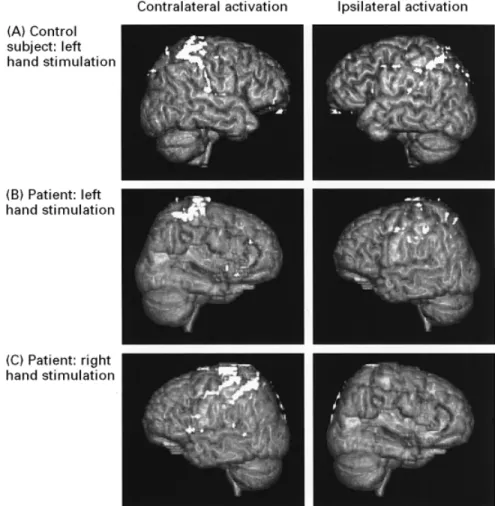 Fig. 5 Ipsilateral and contralateral activations elicited by sensory stimulation of the left hand in a control subject (A) and the patient (B), and ipsilateral and contralateral activations elicited by sensory stimulation of the right hand in the patient (