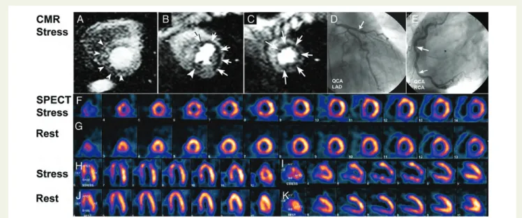 Figure 1 An example of a 67-year-old patient is shown with angina CCS II. The perfusion-cardiac magnetic resonance study during hyper- hyper-aemia (at 0.075 mmol/kg Gd-DTPA-BMA) demonstrates a perfusion deficit in the subendocardium of the anterolateral wa