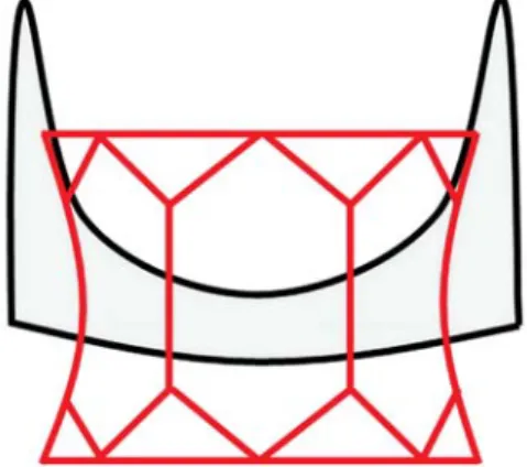 Figure 3: The schematic positioning of a Sapien™ within an Edwards Perimount ™ aortic bioprosthesis.