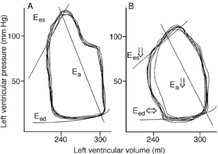 Fig 5 Schematic depiction of left ventricular volume±pressure loops in a patient with heart failure